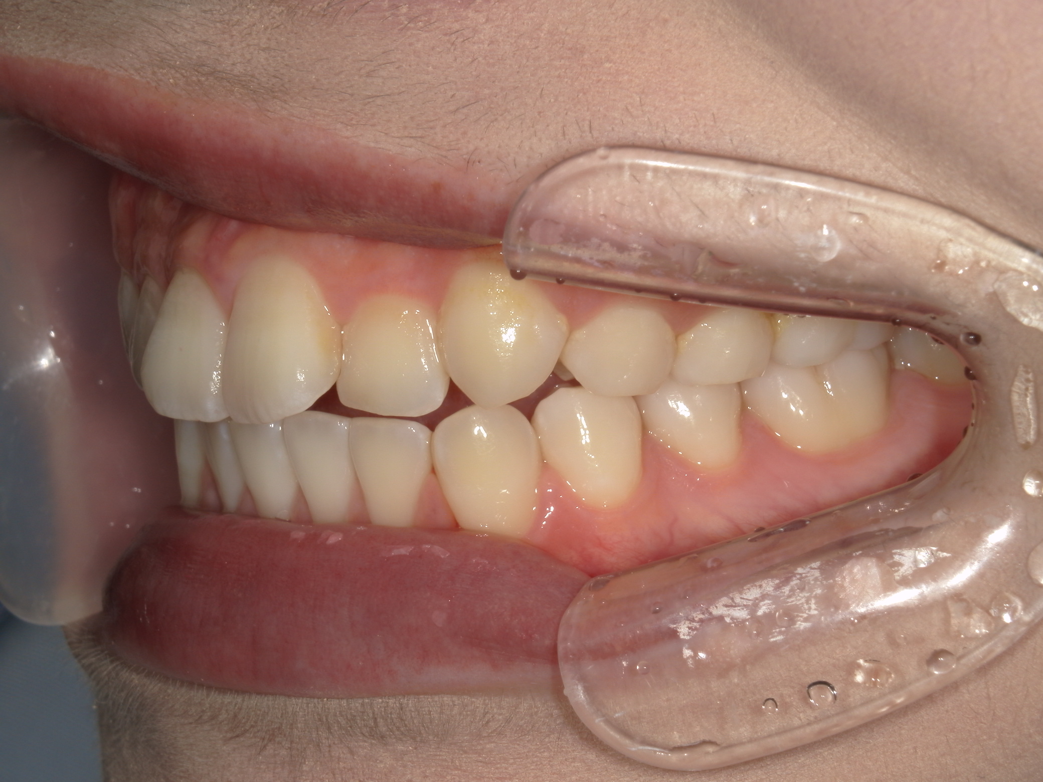 インビザライン矯正　症例（22）