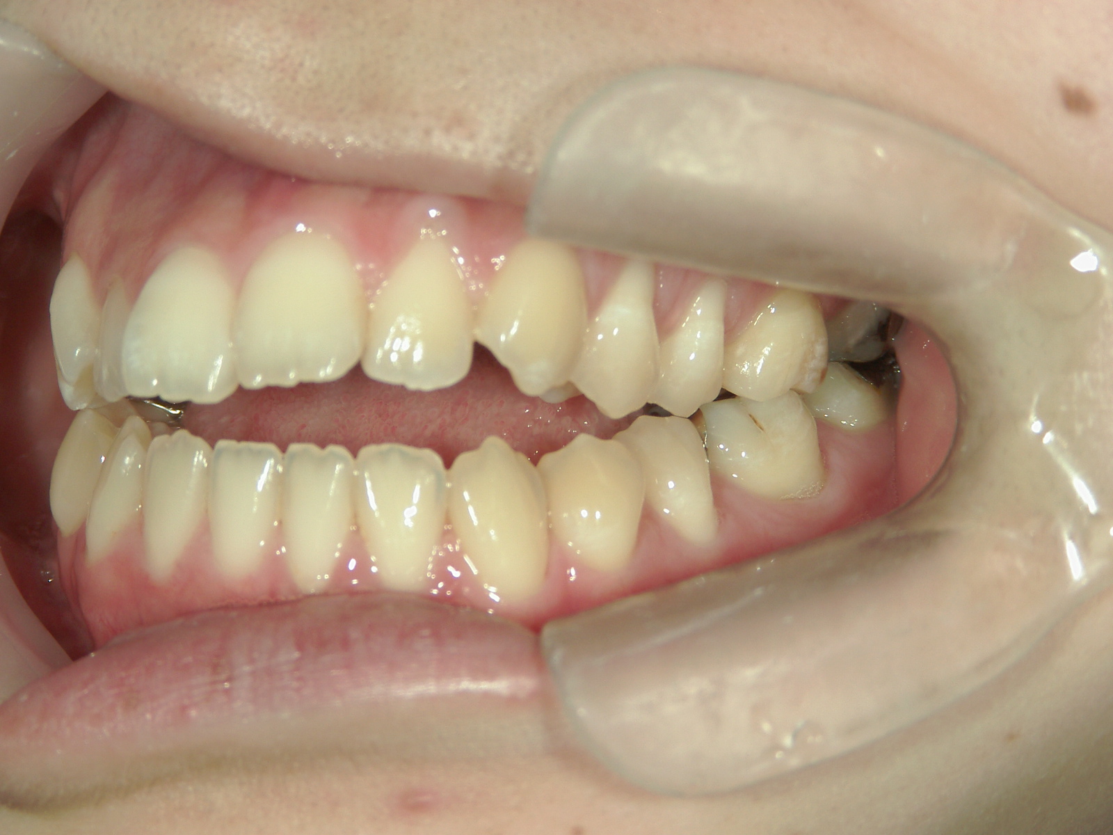 インビザライン矯正　症例（23）