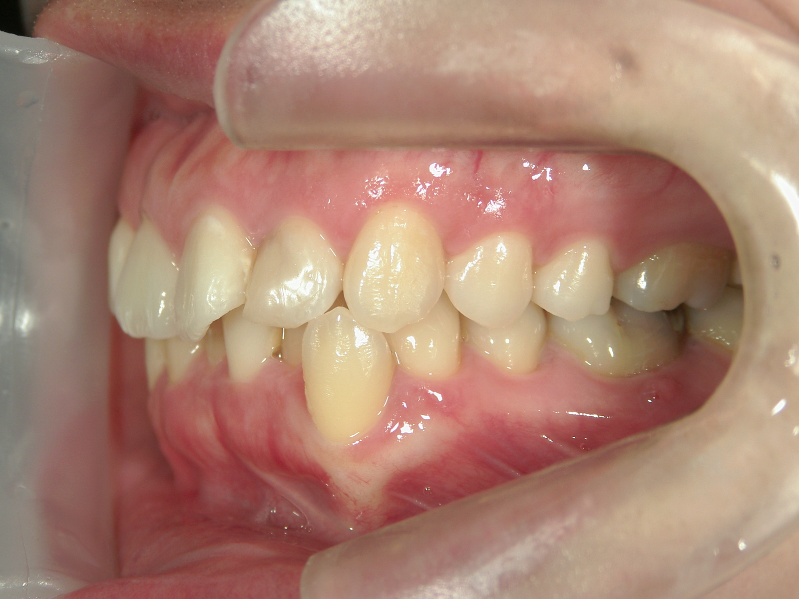 舌側ワイヤー矯正　症例（25）