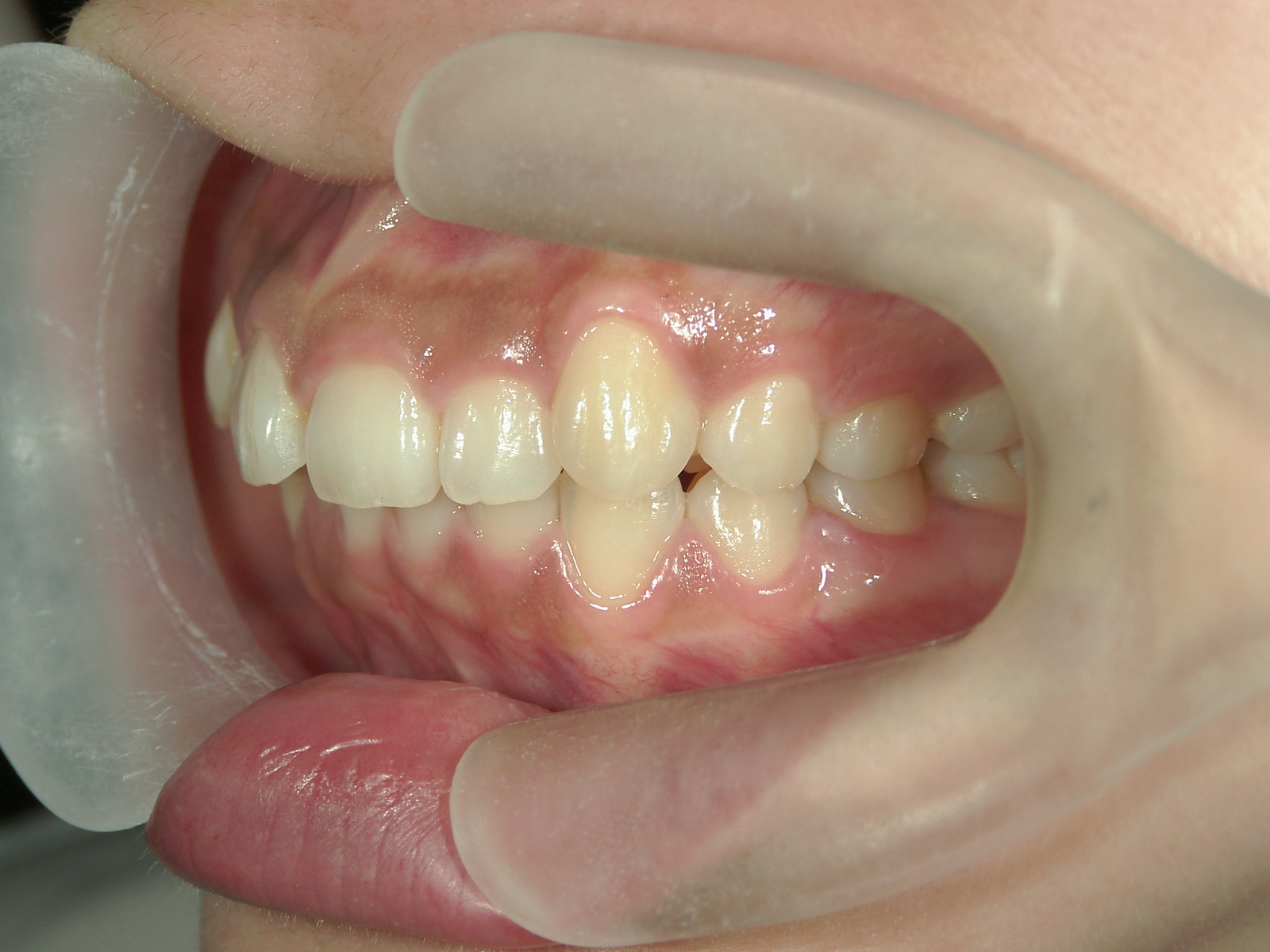 舌側ワイヤー矯正　症例（26）