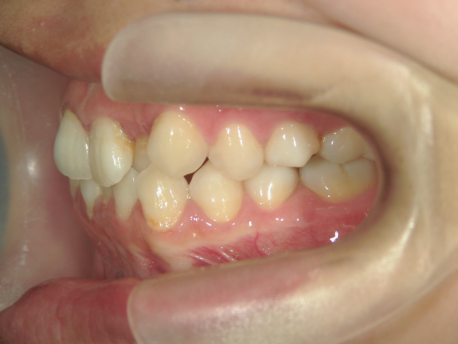 プチ舌側ワイヤー矯正　症例（27）