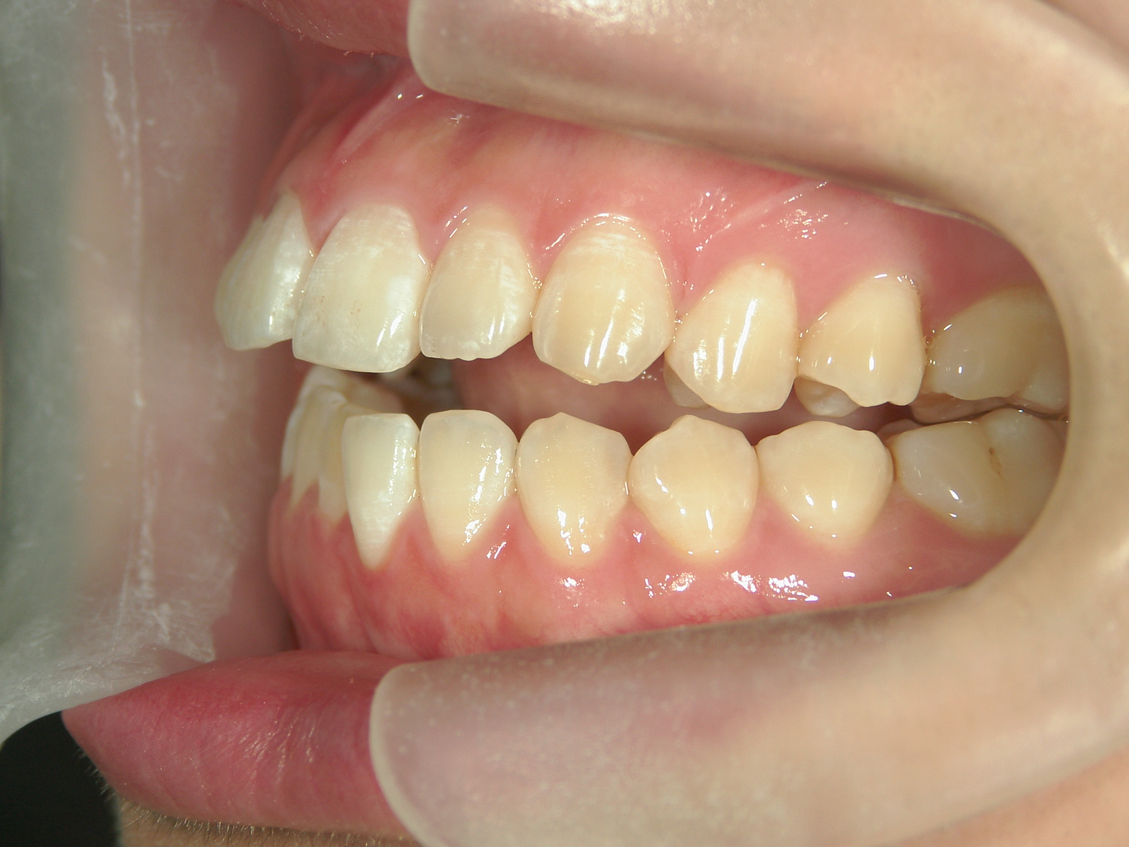 舌側ワイヤー矯正　症例（28）