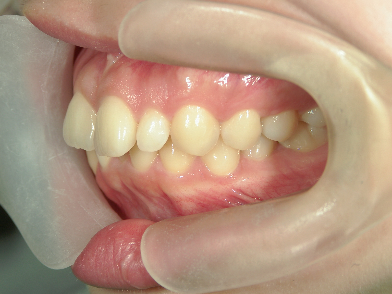 舌側ワイヤー矯正　症例（29）