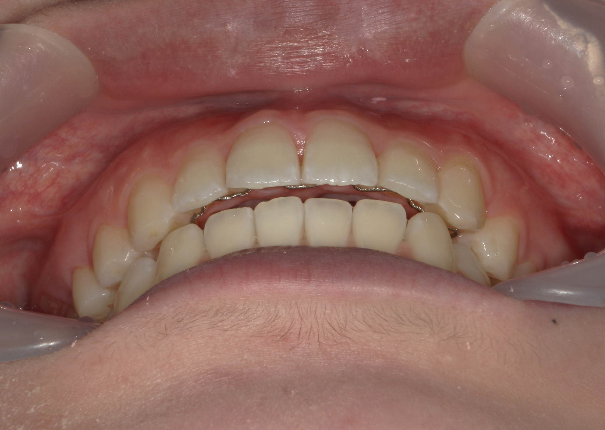 インビザライン矯正　症例（22）