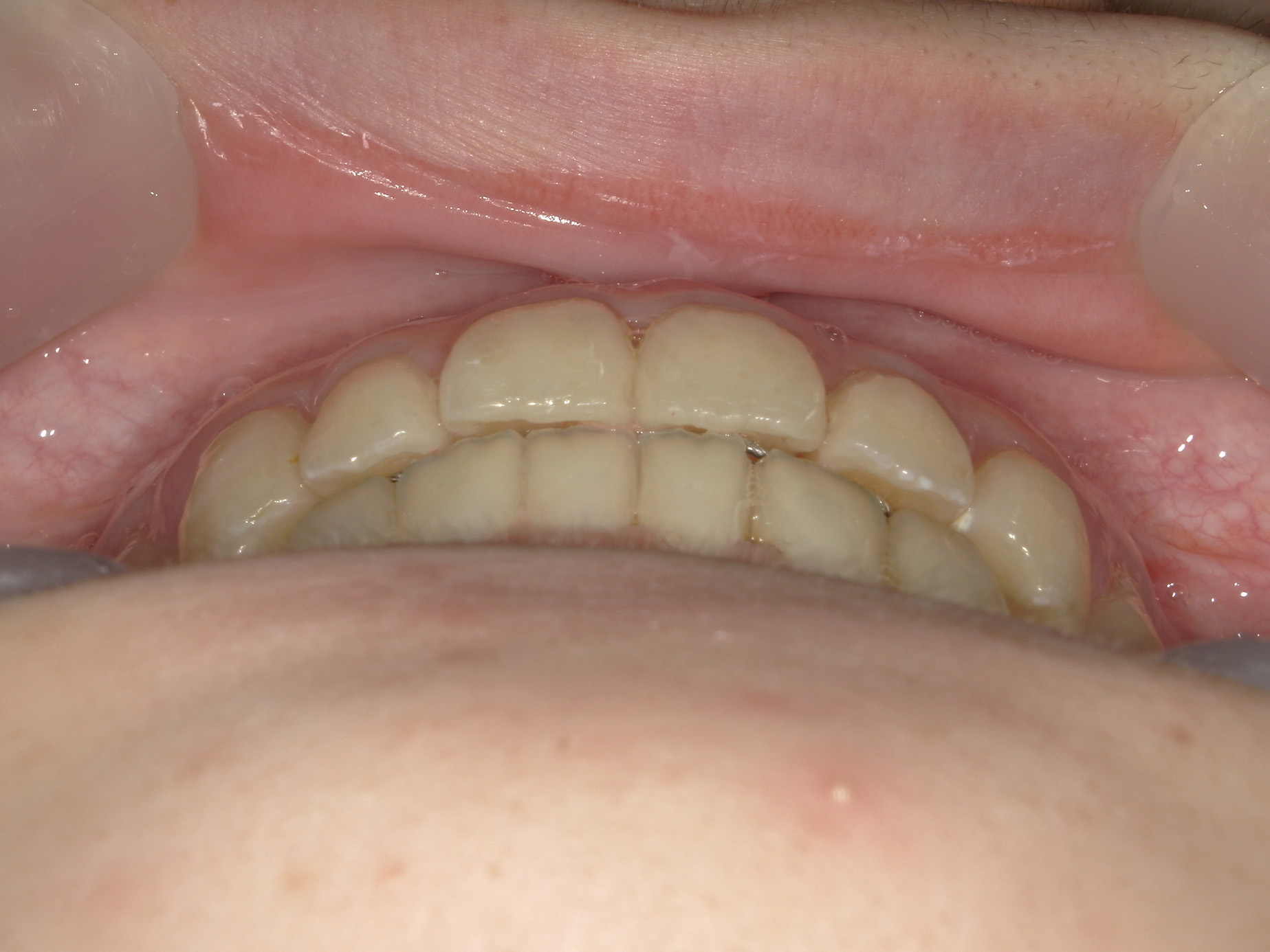 インビザライン矯正　症例（23）