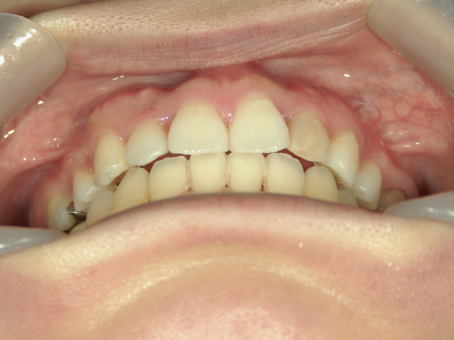 舌側ワイヤー矯正　症例（25）