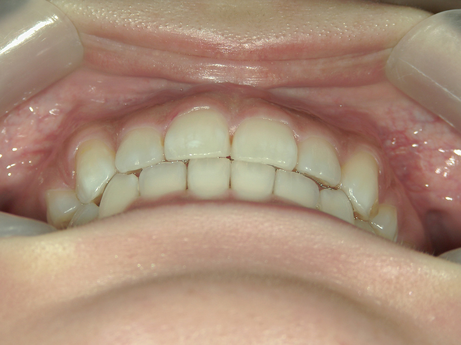 舌側ワイヤー矯正　症例（26）