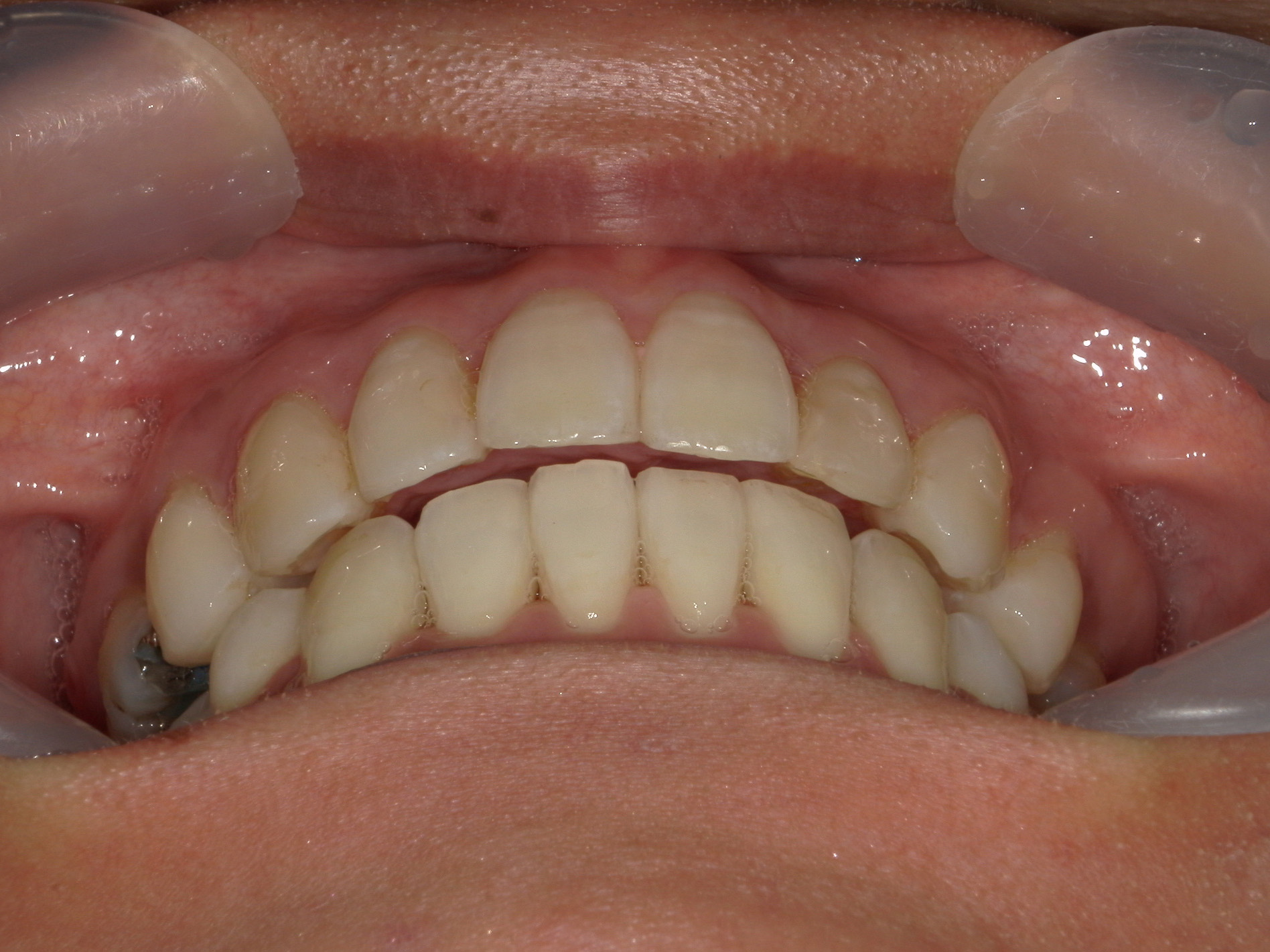 舌側ワイヤー矯正　症例（30）