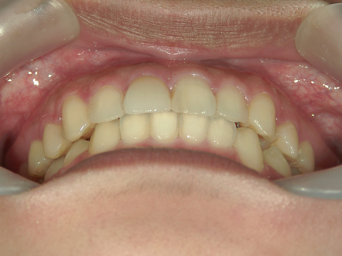 補綴併用症例（3）