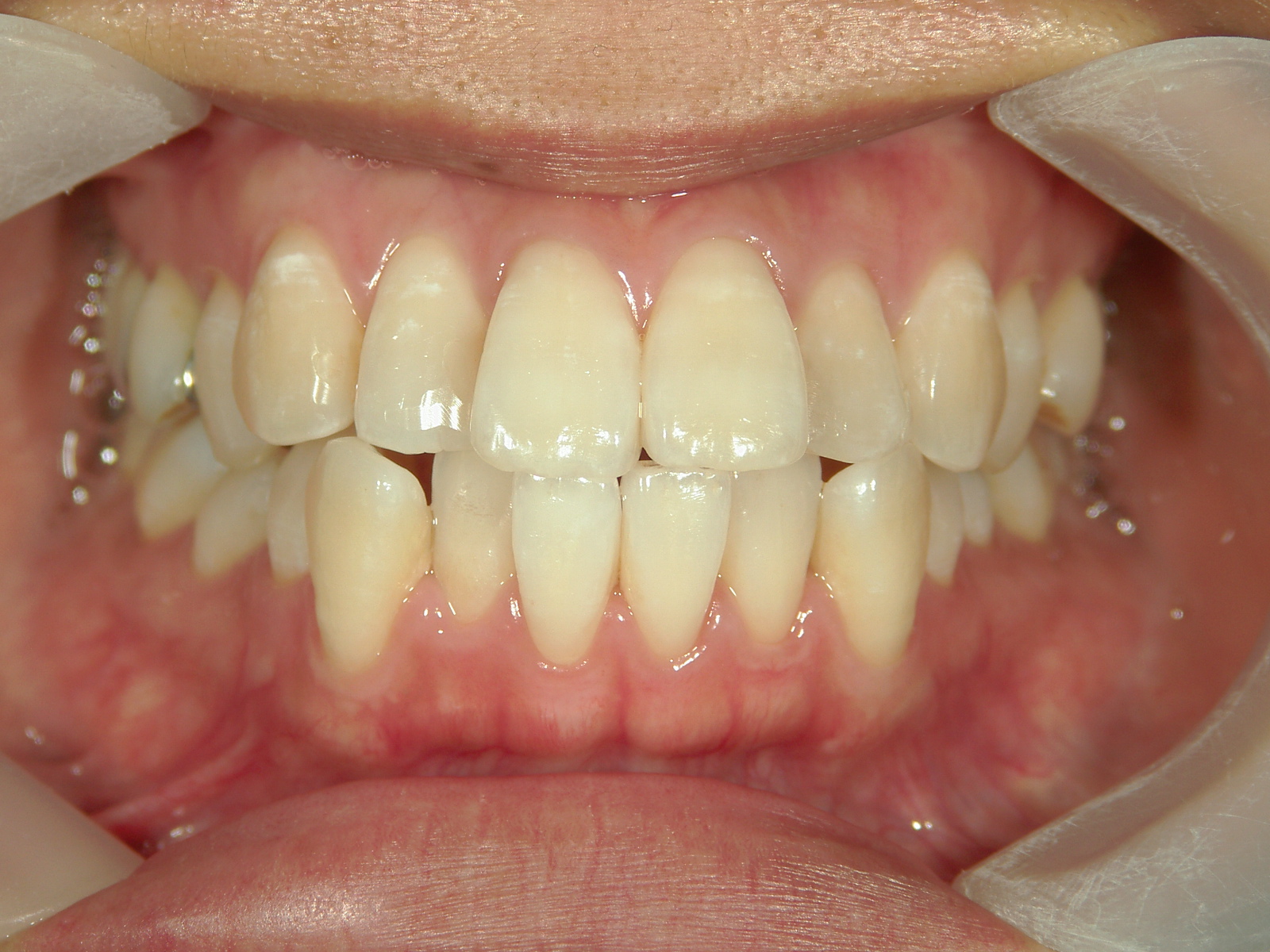 舌側ワイヤー矯正　症例（30）