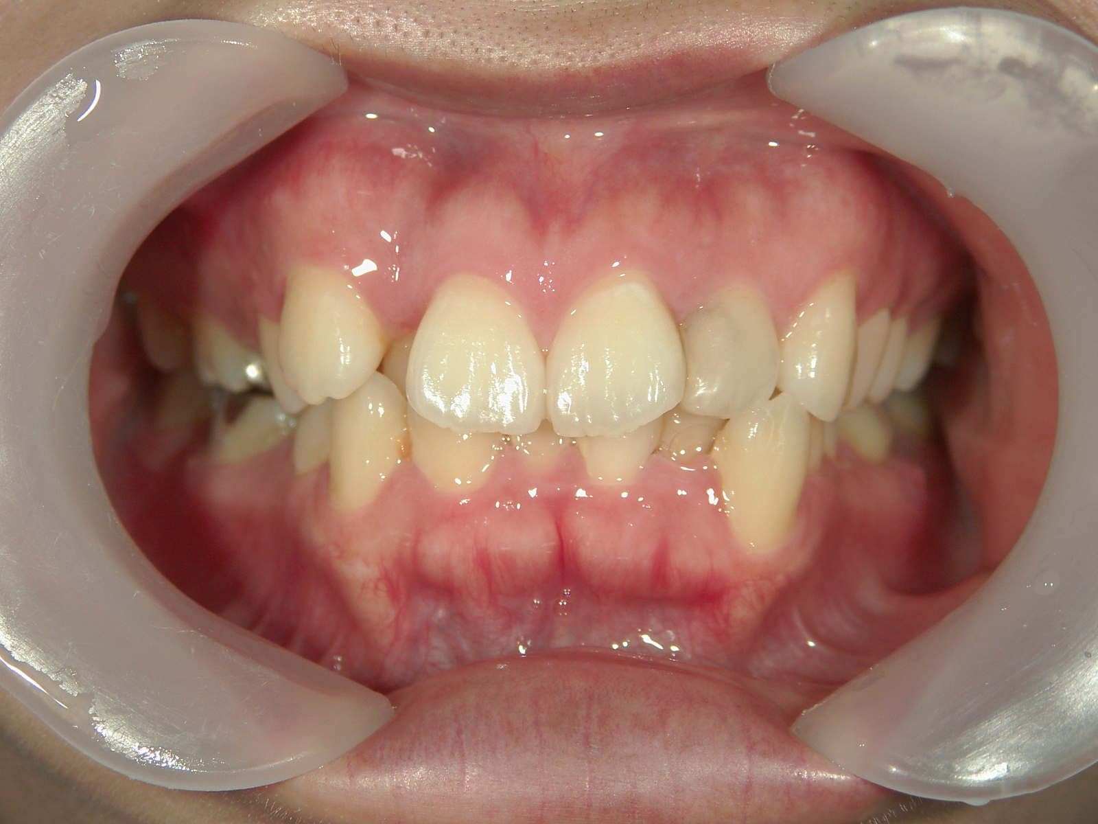 舌側ワイヤー矯正　症例（25）