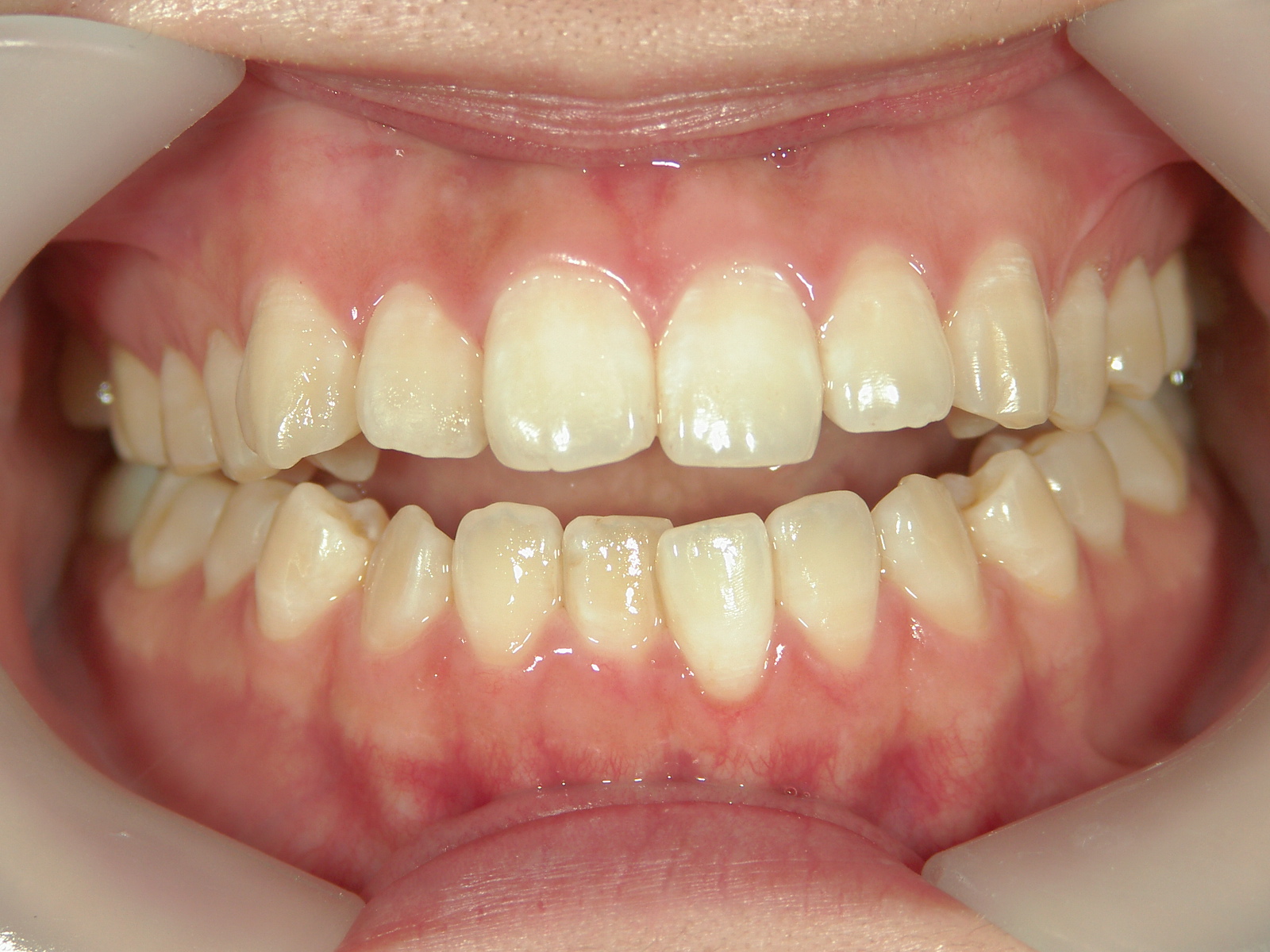 舌側ワイヤー矯正　症例（28）