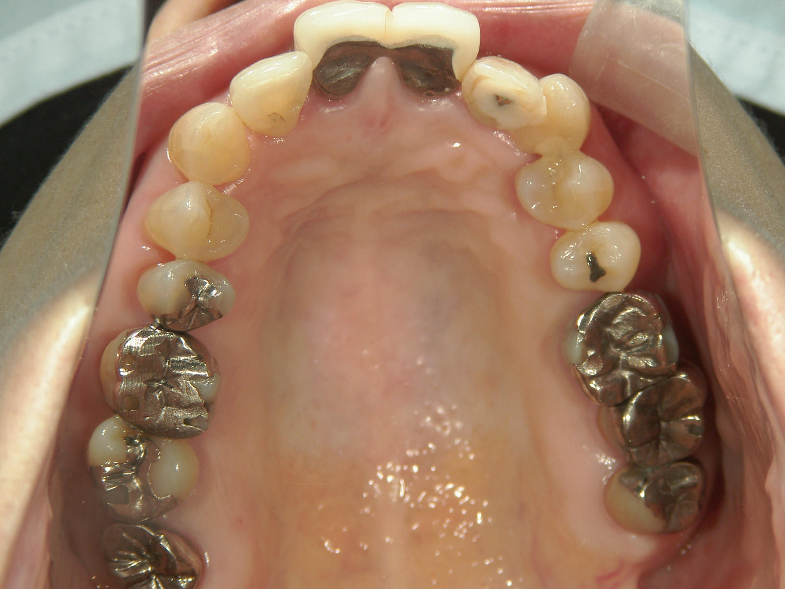 補綴併用症例（2）