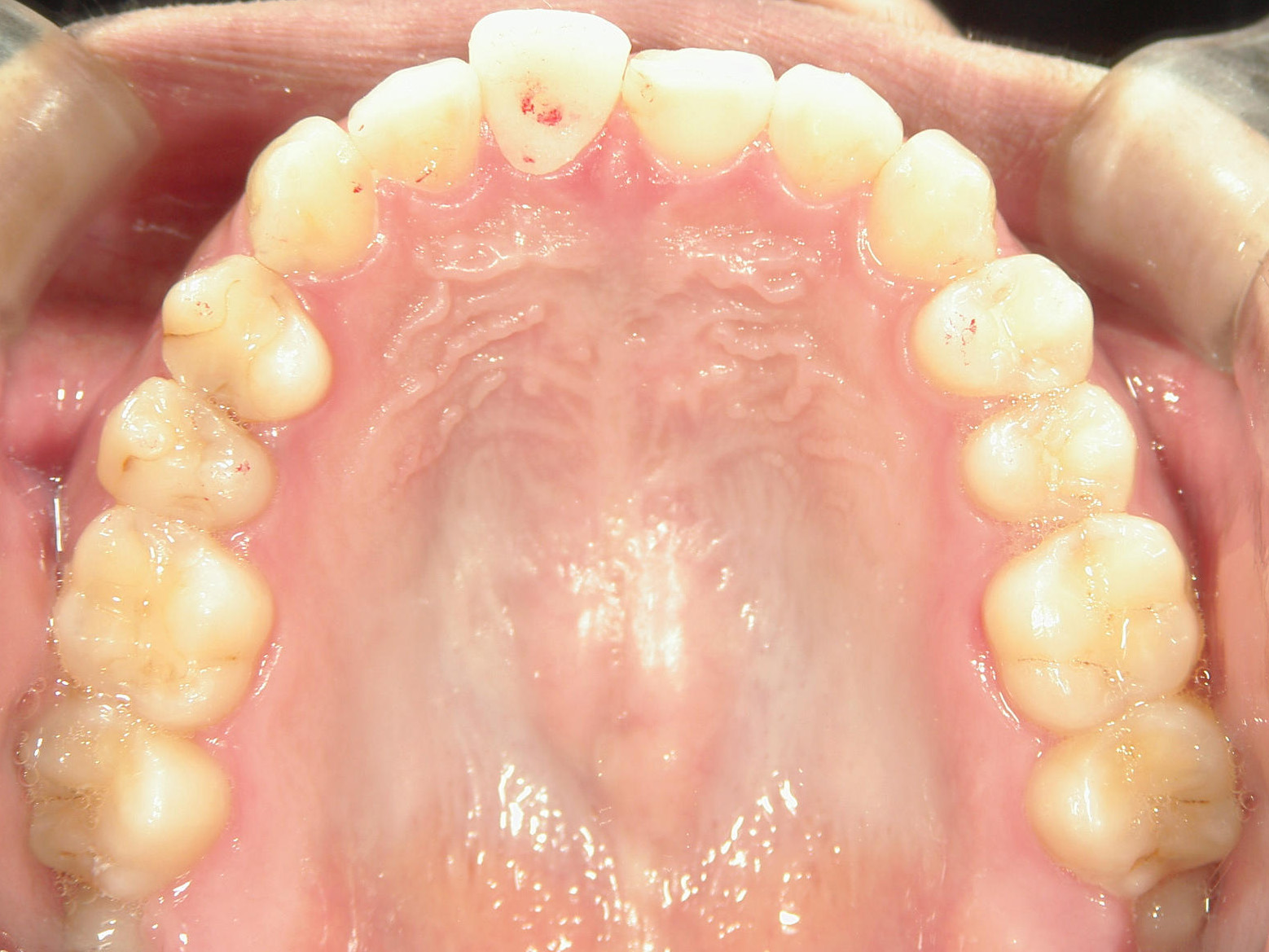 補綴併用症例（3）