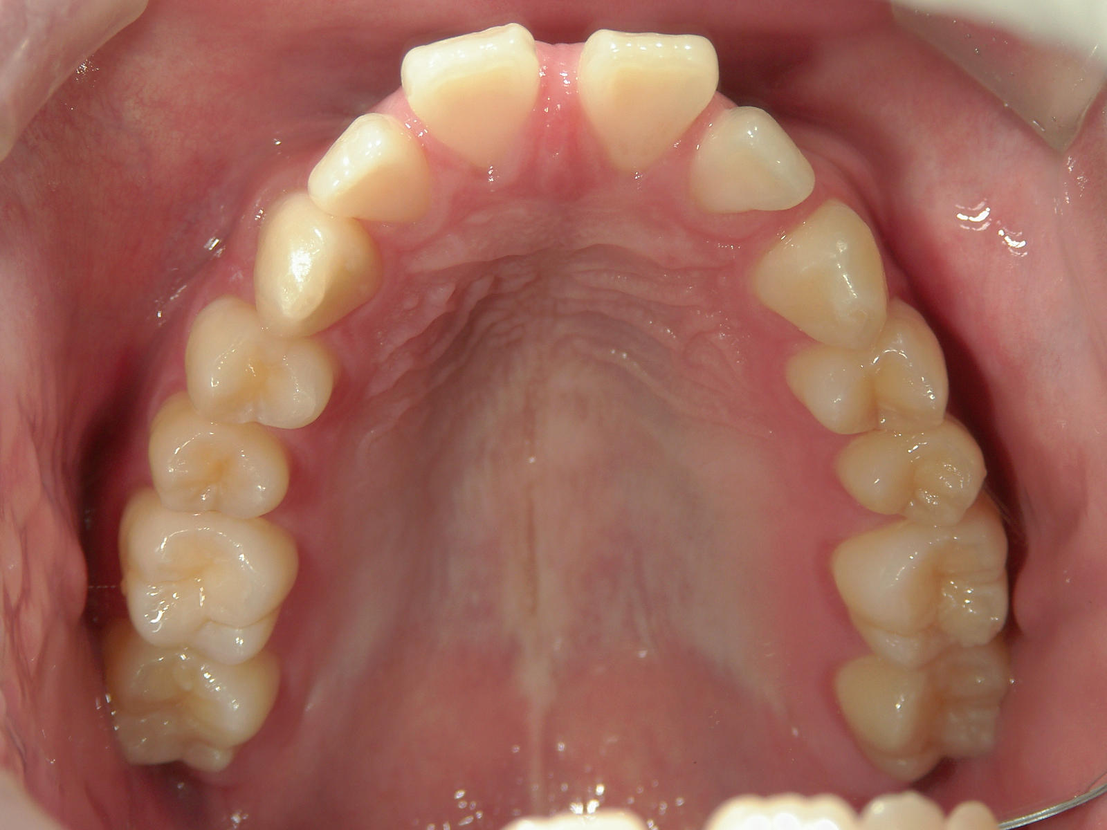 インビザライン矯正　症例（24）