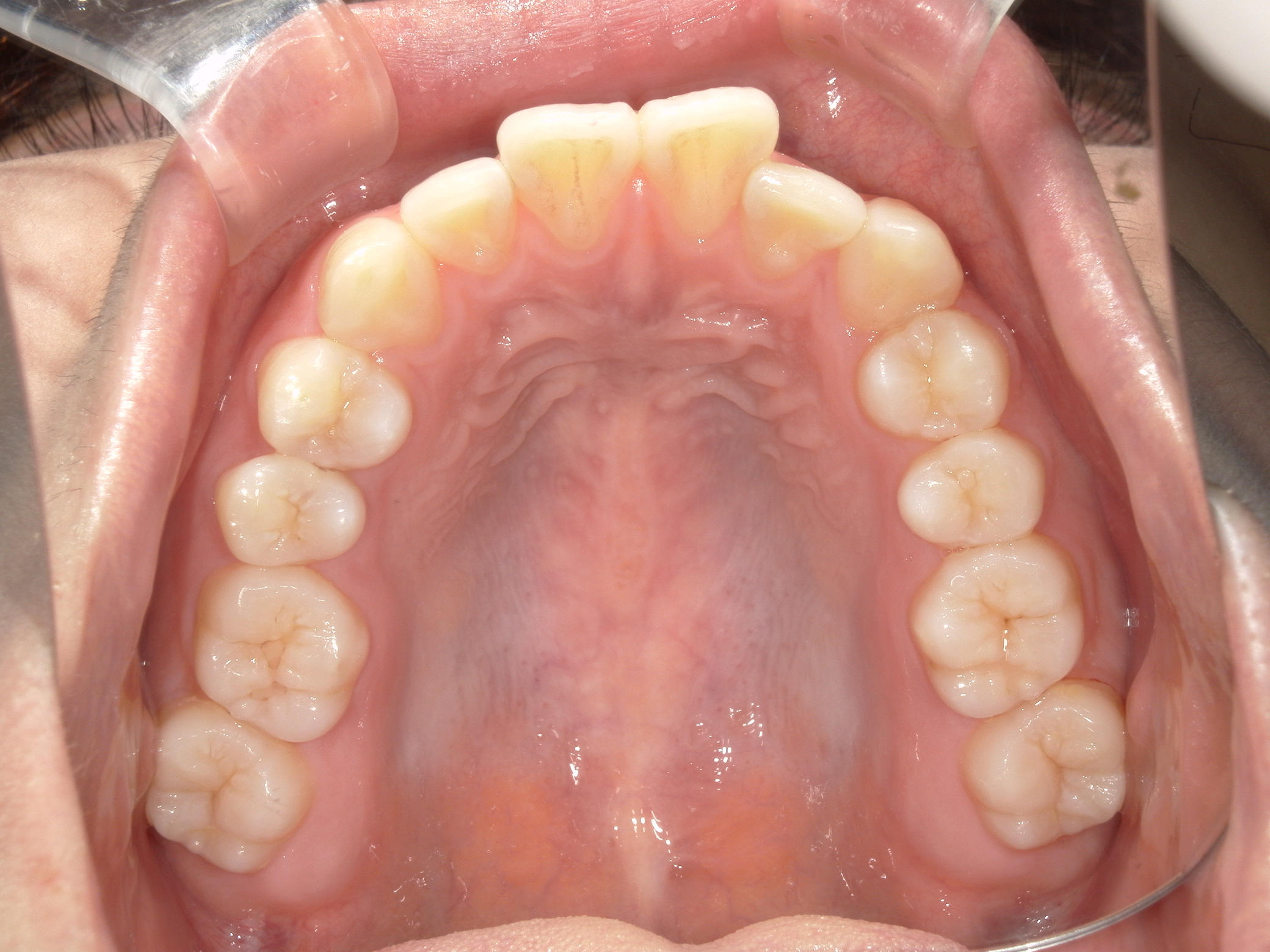 インビザライン矯正　症例（22）