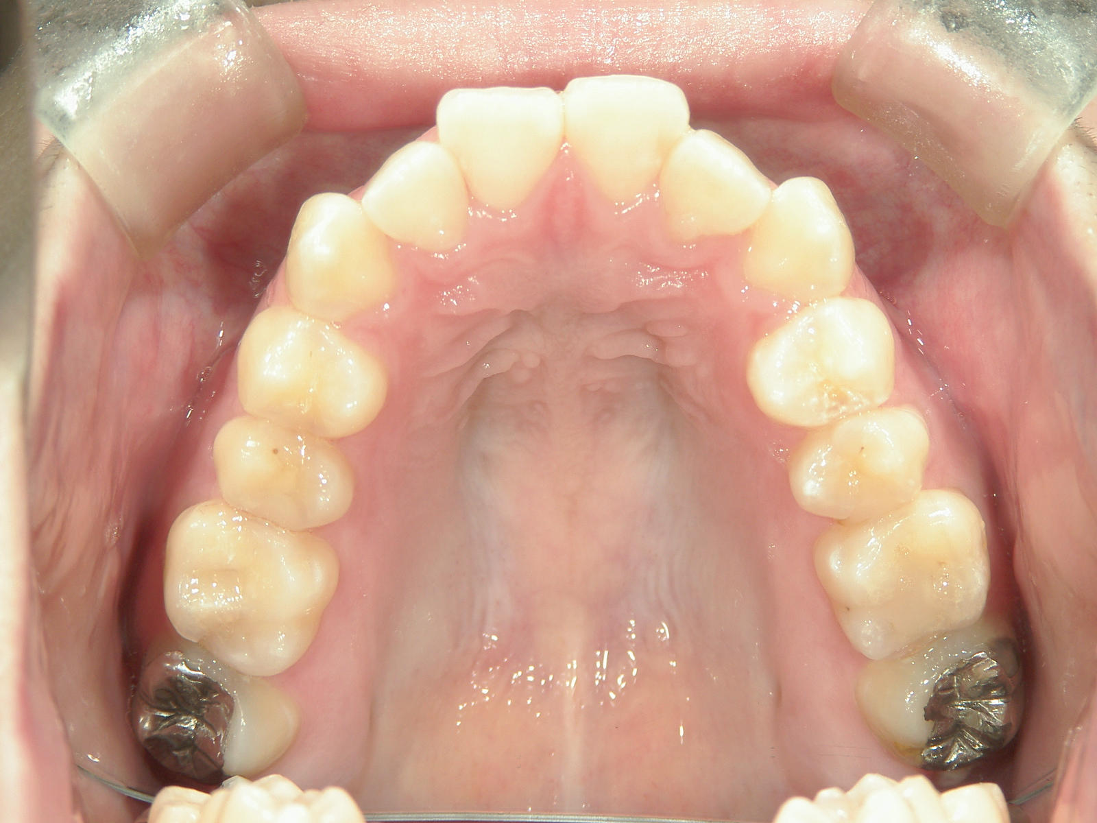 インビザライン矯正　症例（23）