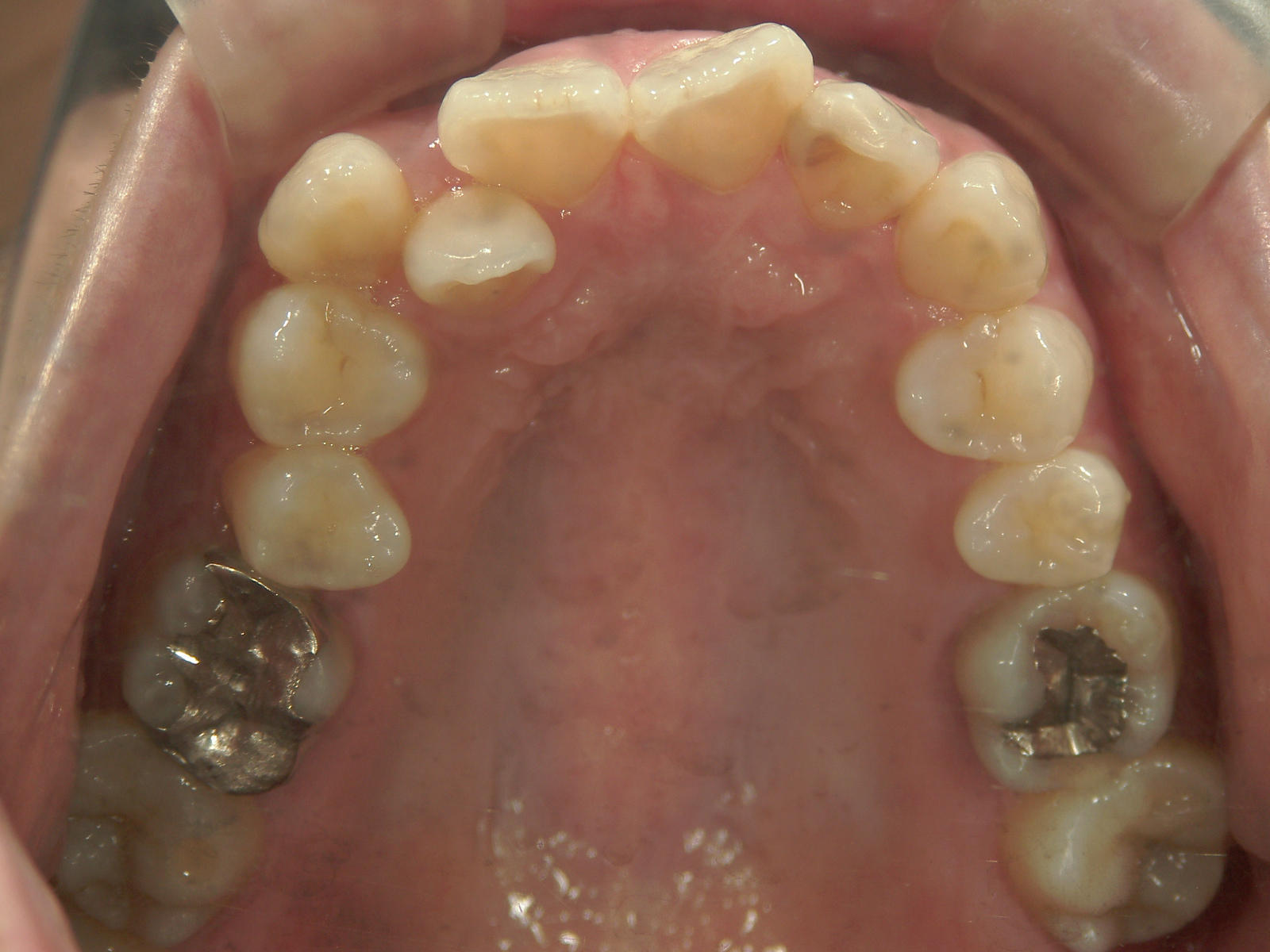 舌側ワイヤー矯正　症例（25）