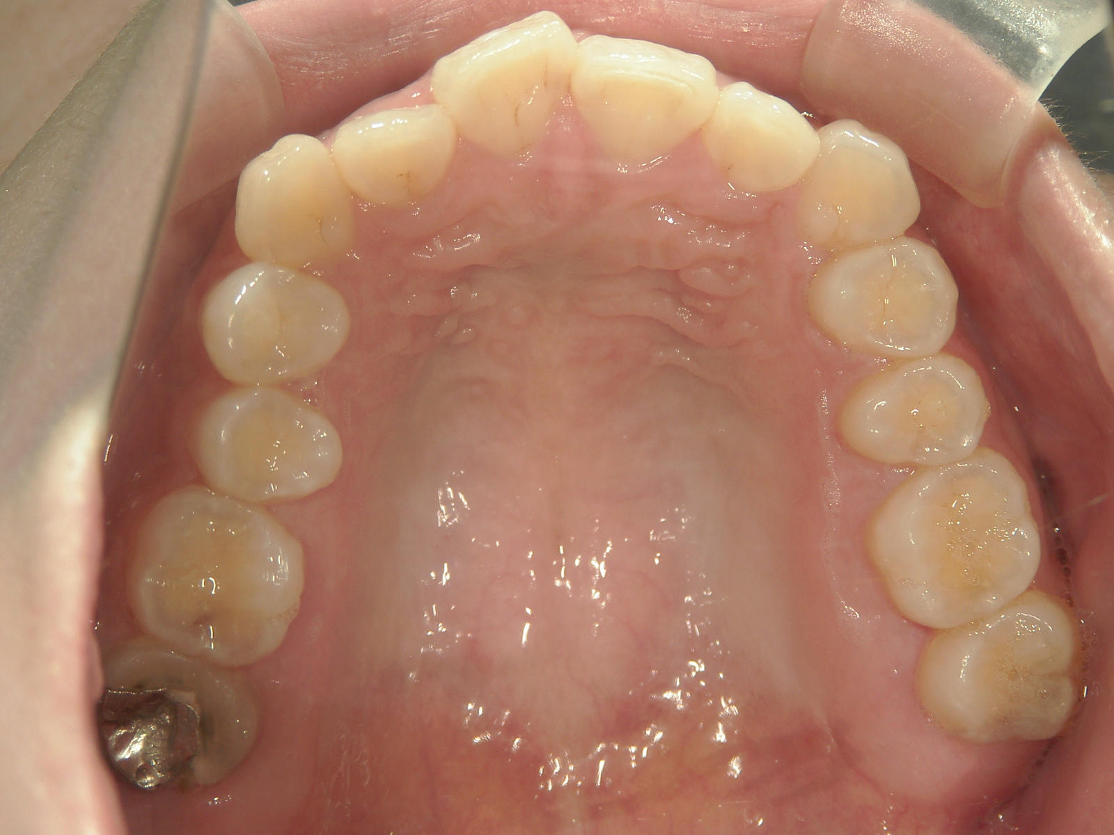 舌側ワイヤー矯正　症例（26）