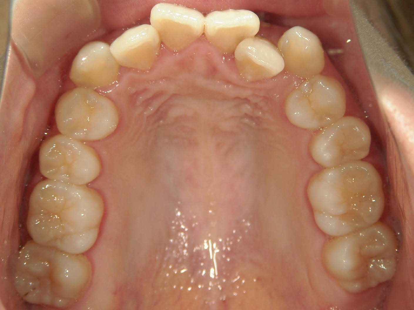プチ舌側ワイヤー矯正　症例（27）