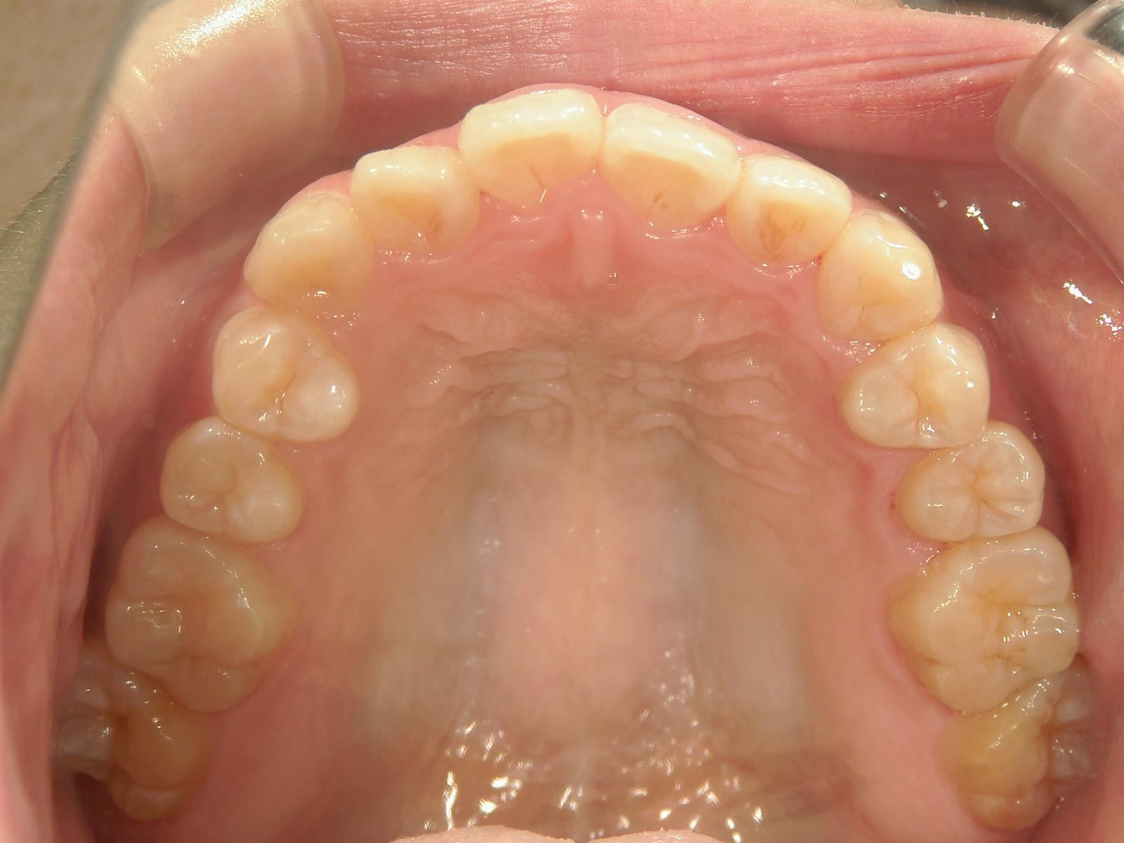 舌側ワイヤー矯正　症例（28）