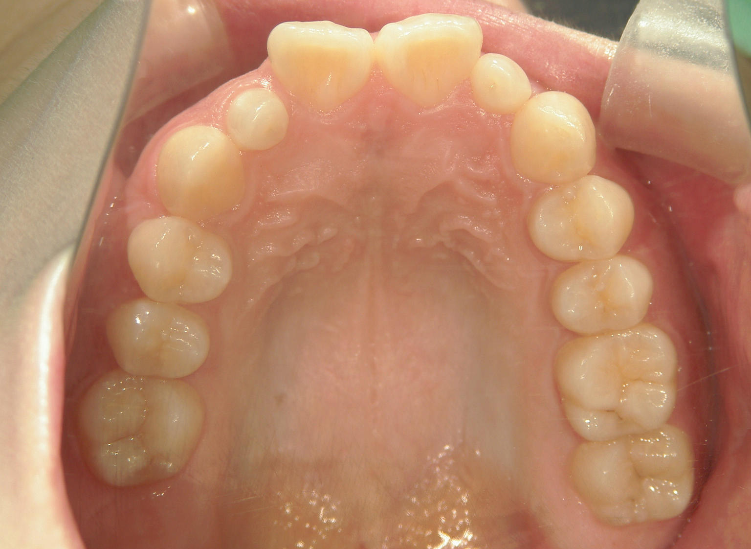 舌側ワイヤー矯正　症例（29）