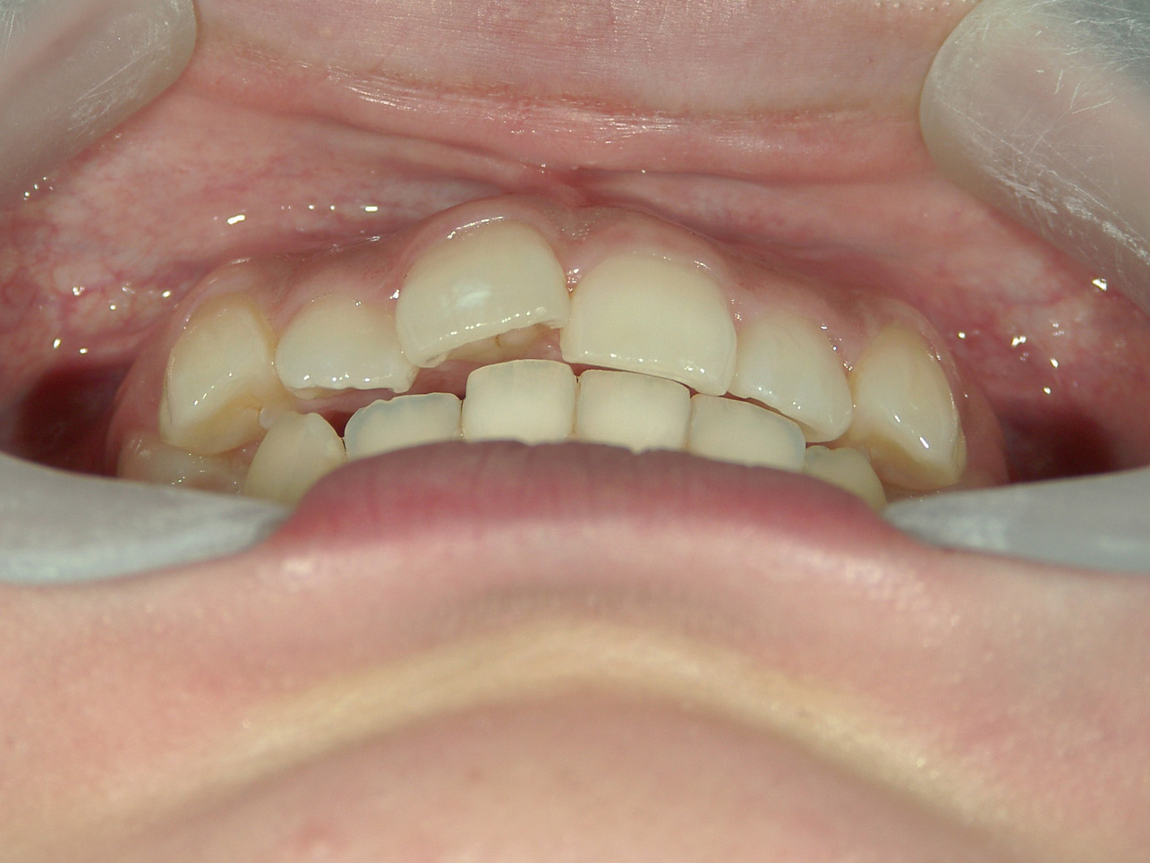 舌側ワイヤー矯正　症例（26）