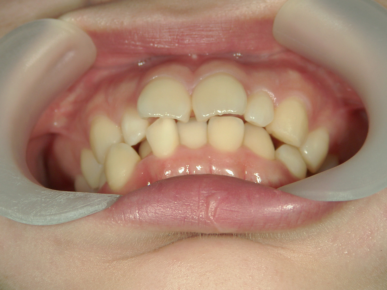 舌側ワイヤー矯正　症例（29）