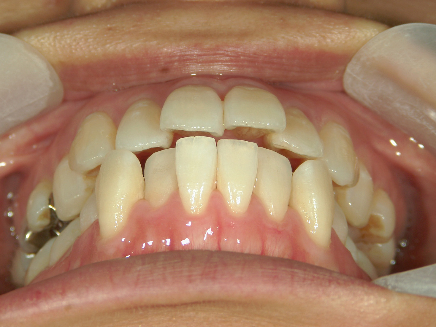 舌側ワイヤー矯正　症例（30）