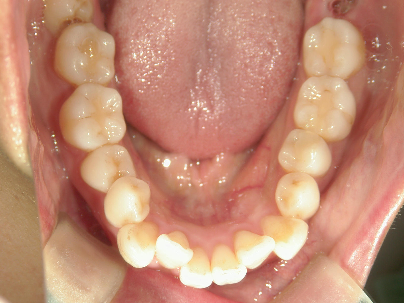 舌側ワイヤー矯正　症例（30）