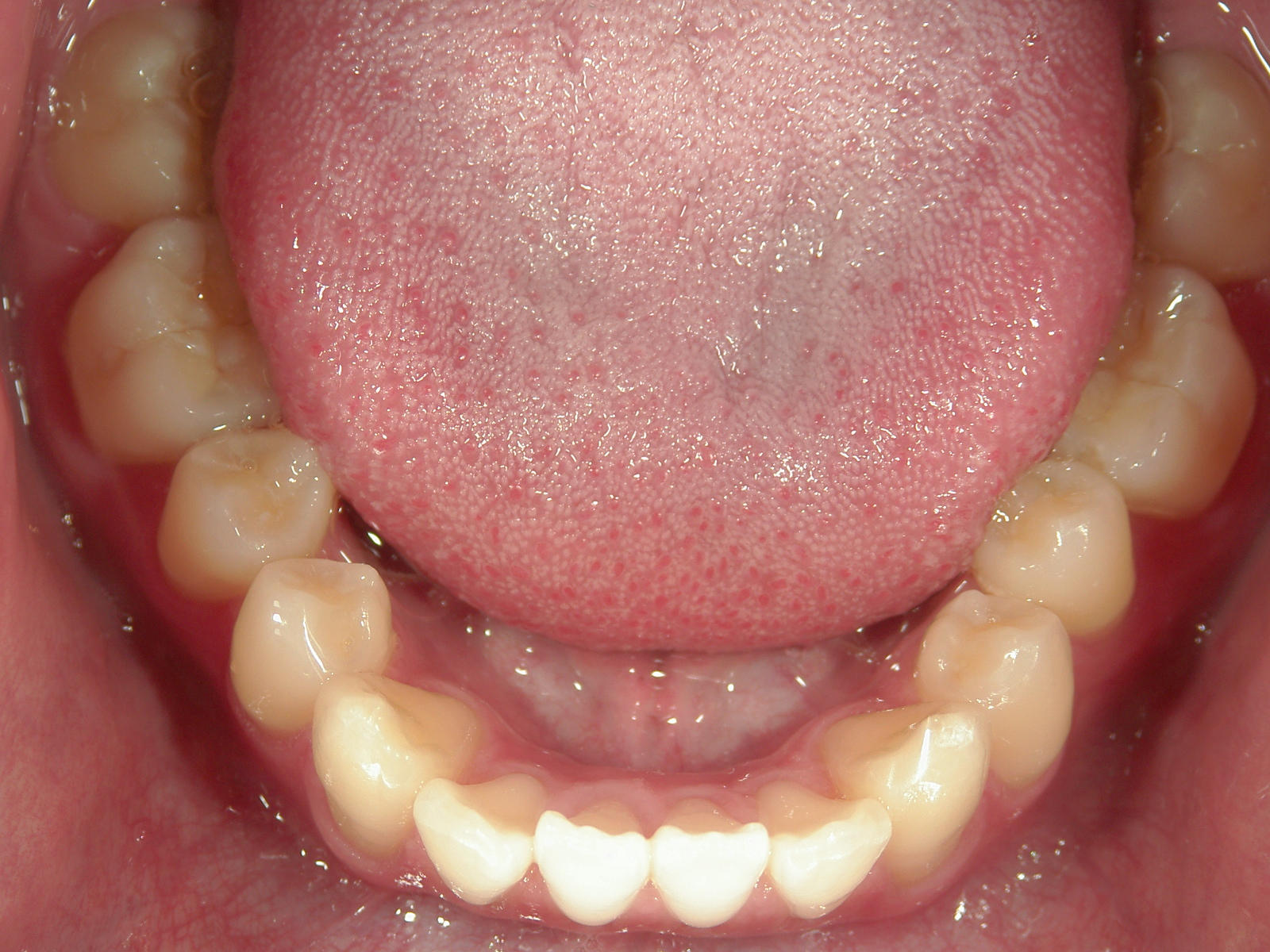 インビザライン矯正　症例（24）