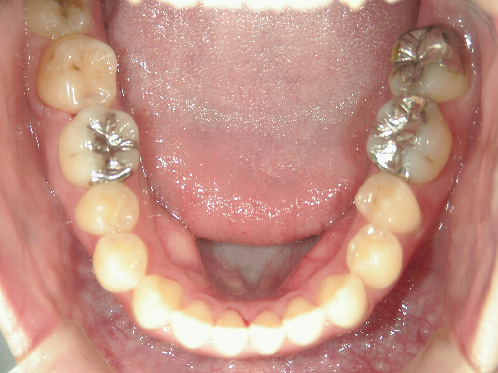 インビザライン矯正　症例（23）