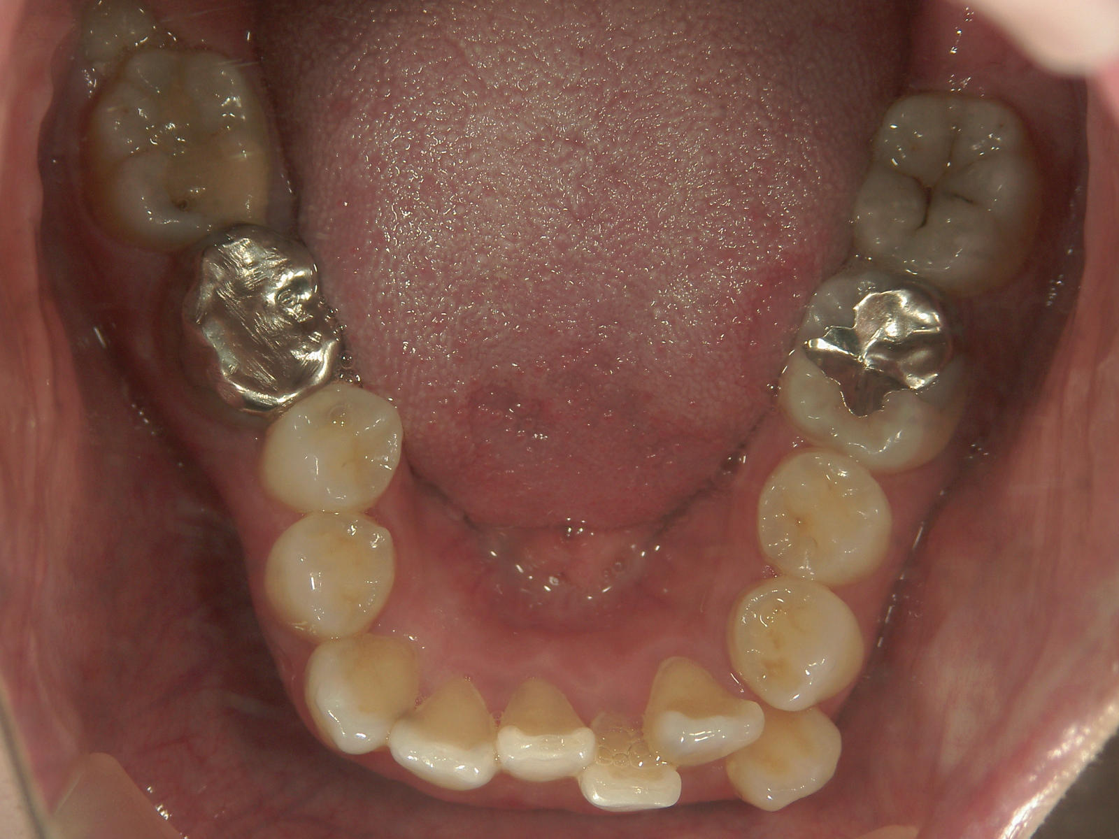 舌側ワイヤー矯正　症例（25）