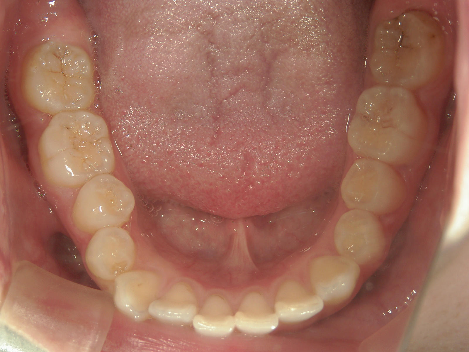 舌側ワイヤー矯正　症例（26）