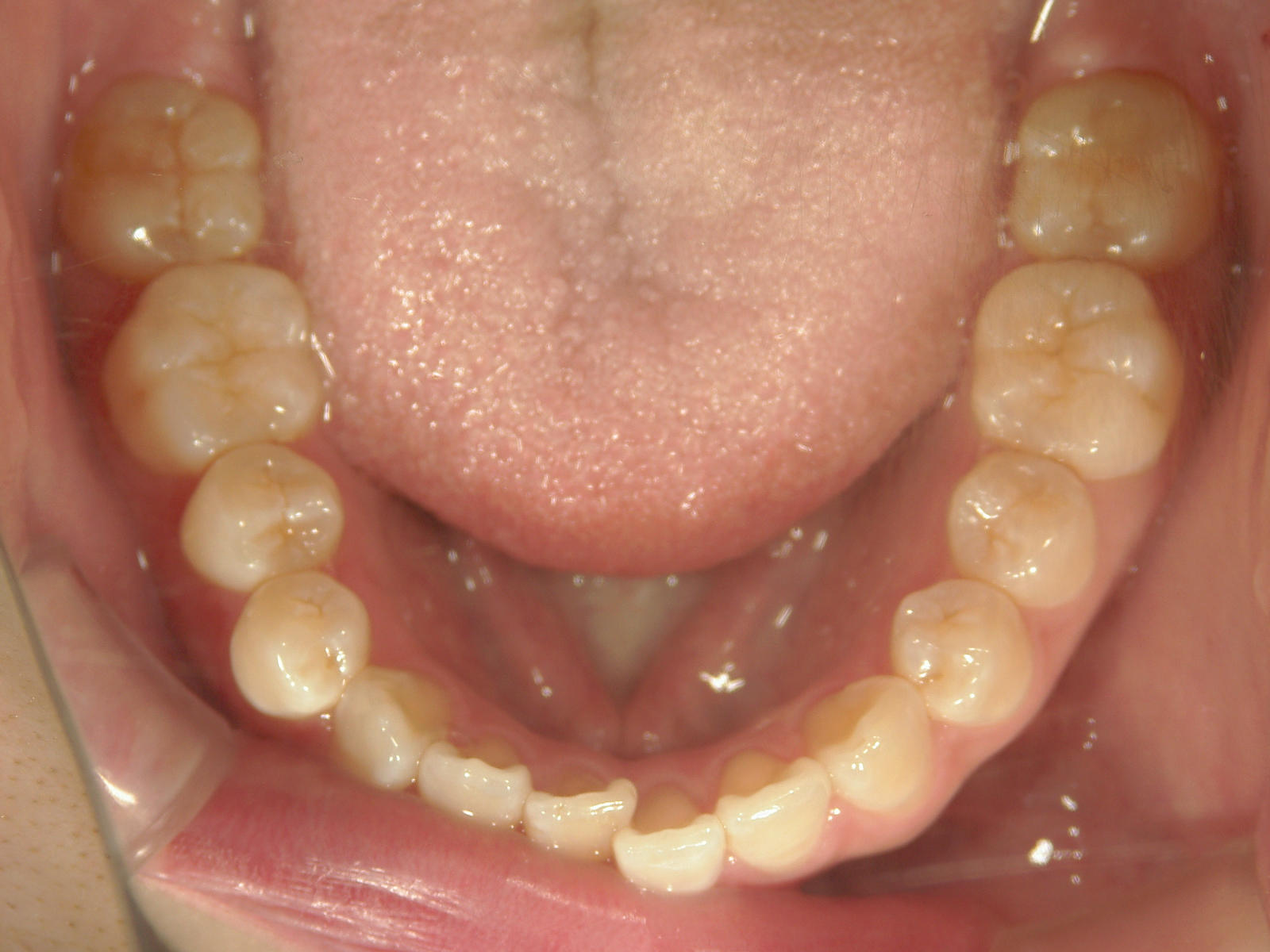 舌側ワイヤー矯正　症例（28）