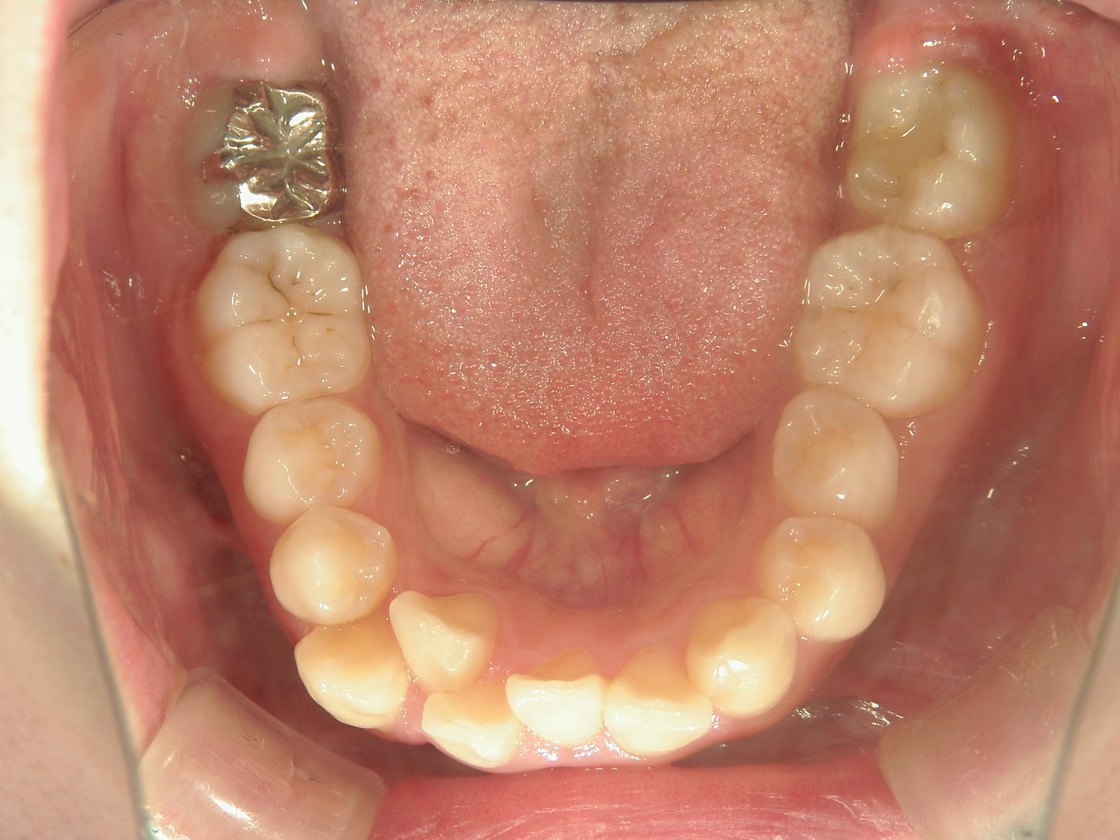 舌側ワイヤー矯正　症例（29）