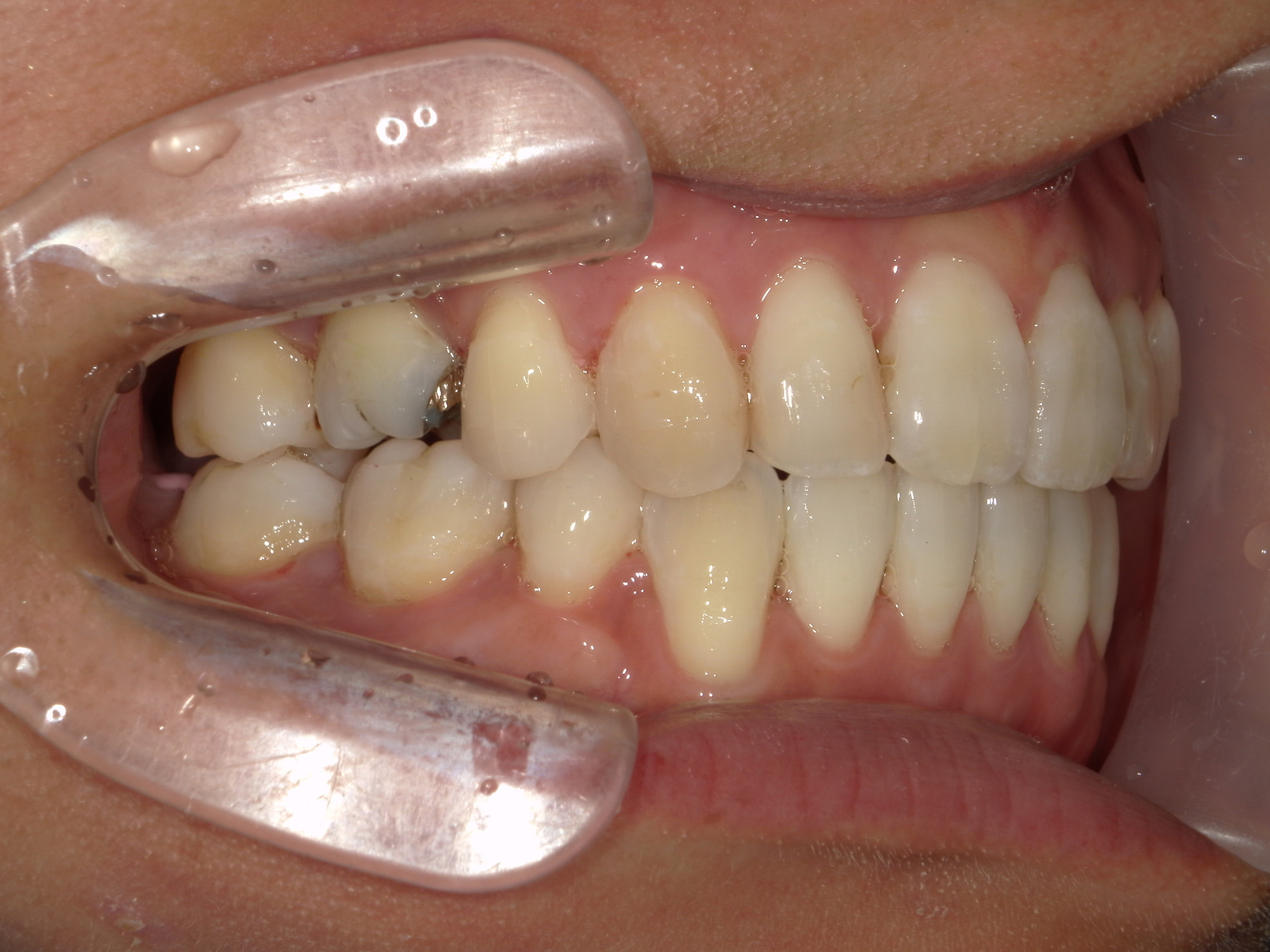 舌側ワイヤー矯正　症例（30）