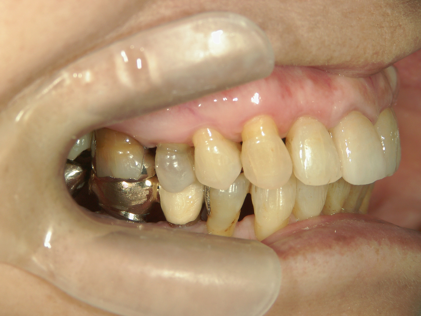 補綴併用症例（2）