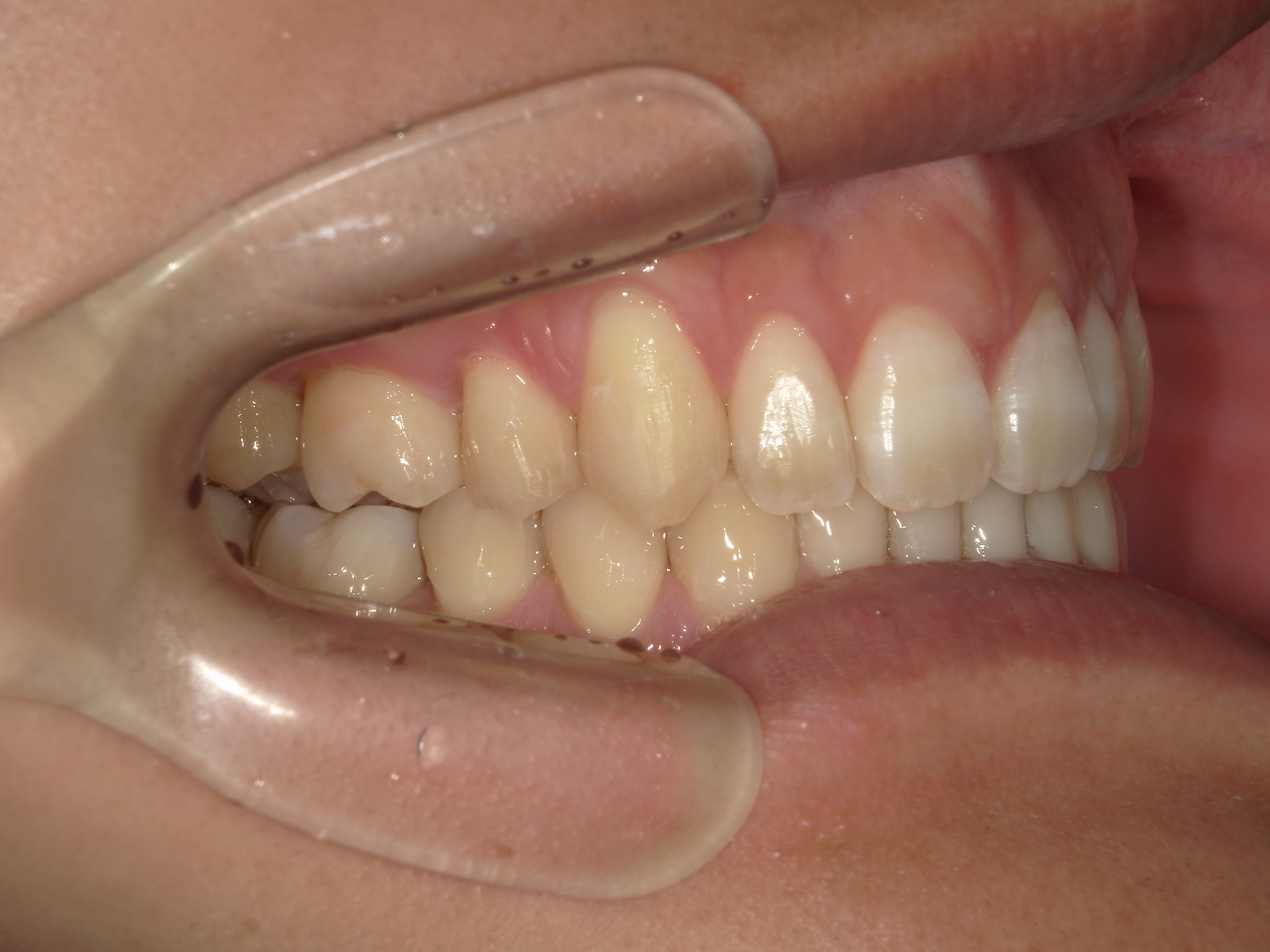 インビザライン矯正　症例（24）