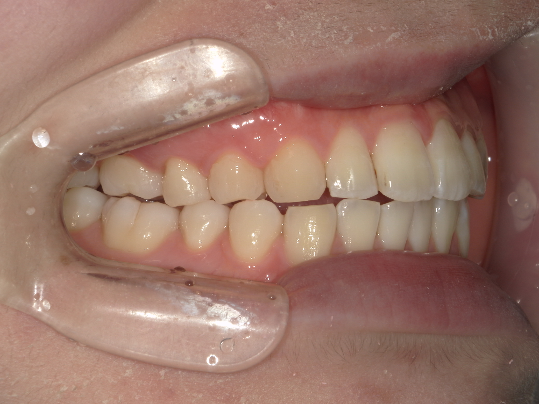 インビザライン矯正　症例（22）