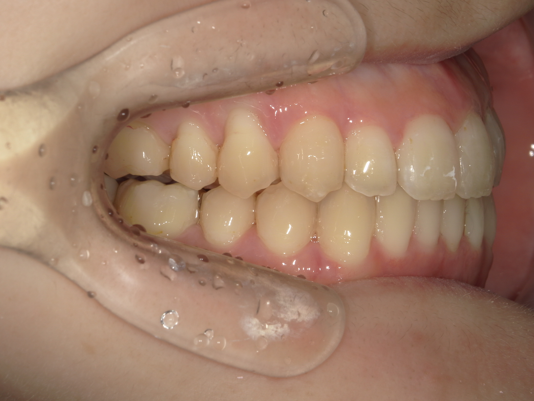 インビザライン矯正　症例（23）