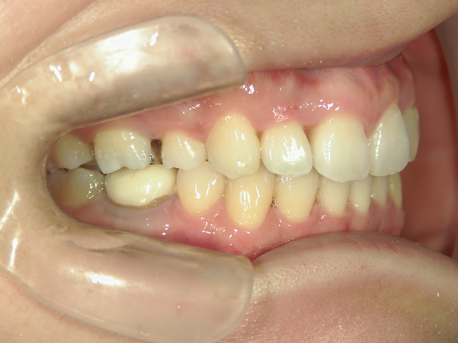 舌側ワイヤー矯正　症例（25）