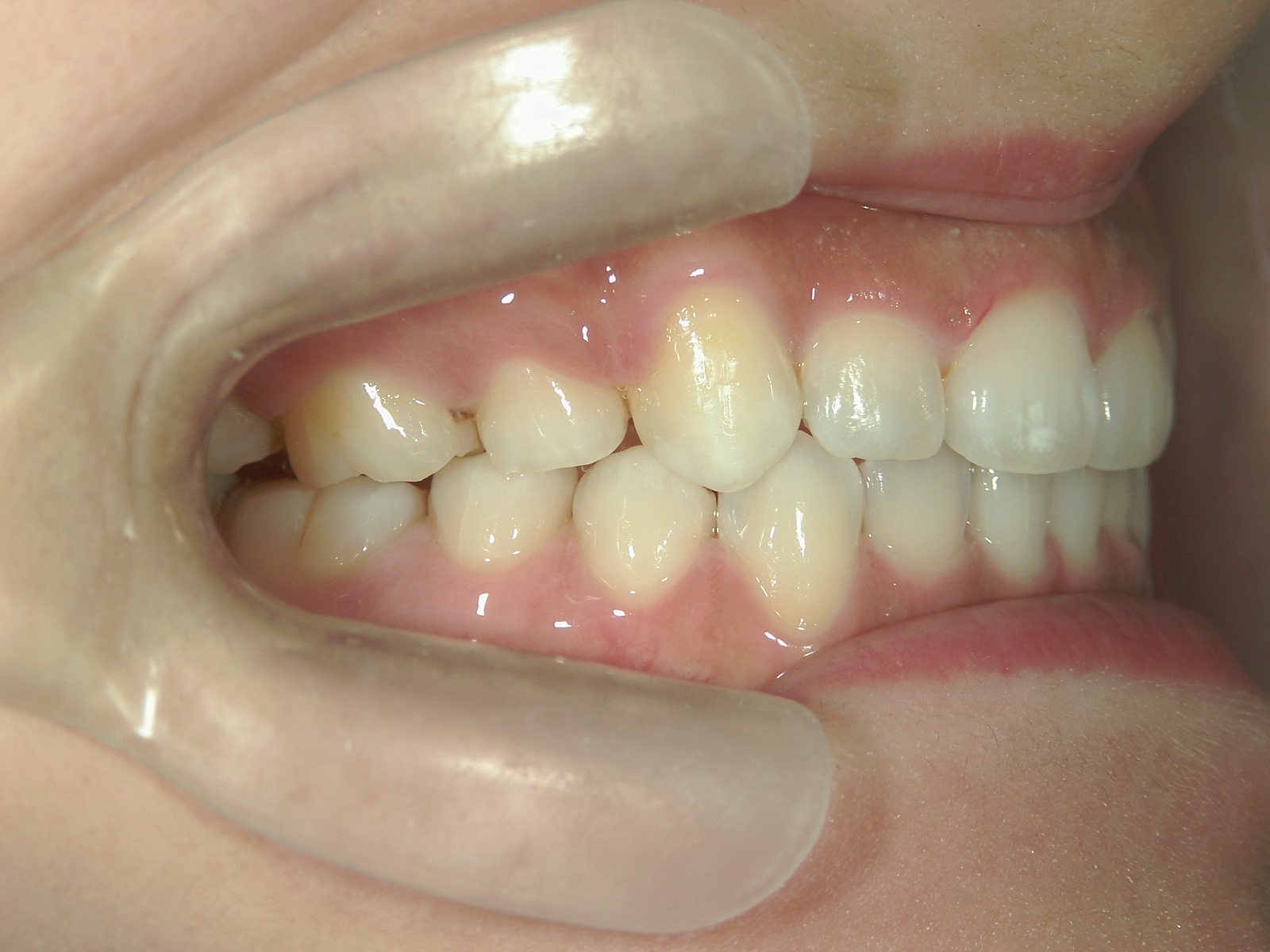 舌側ワイヤー矯正　症例（26）