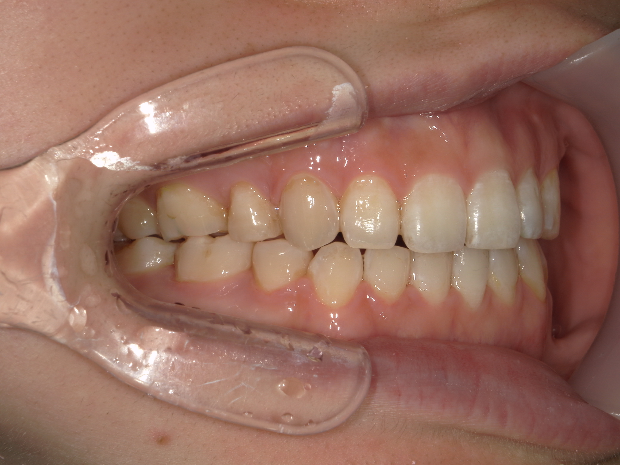 舌側ワイヤー矯正　症例（28）