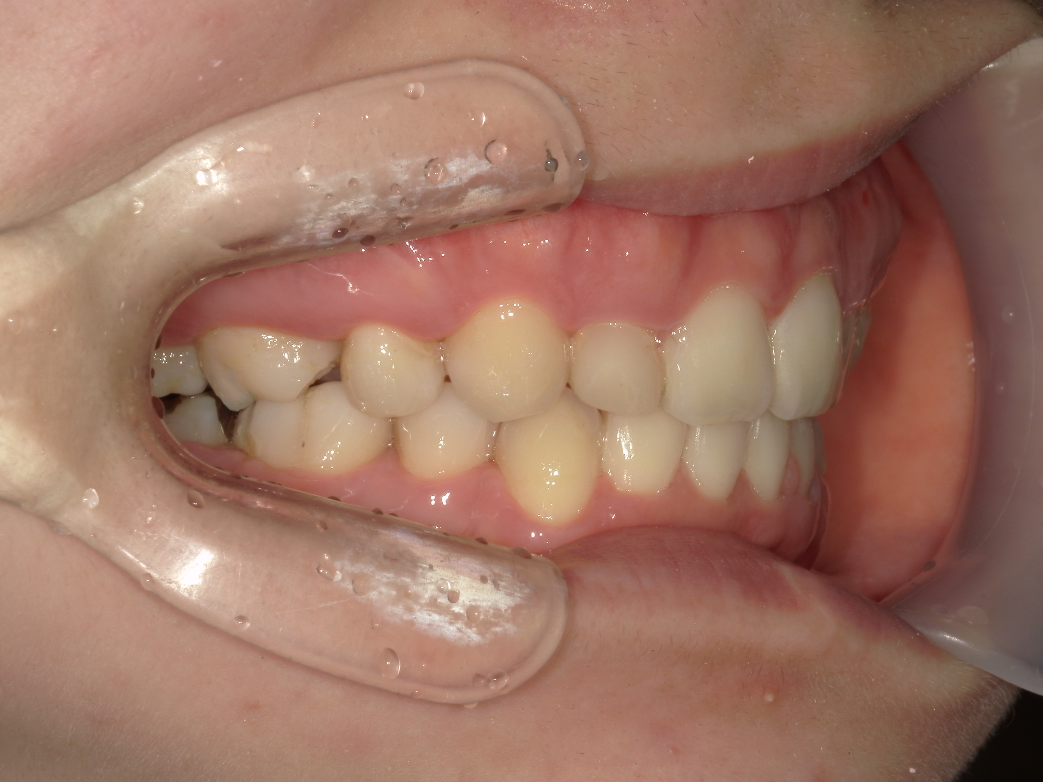 舌側ワイヤー矯正　症例（29）