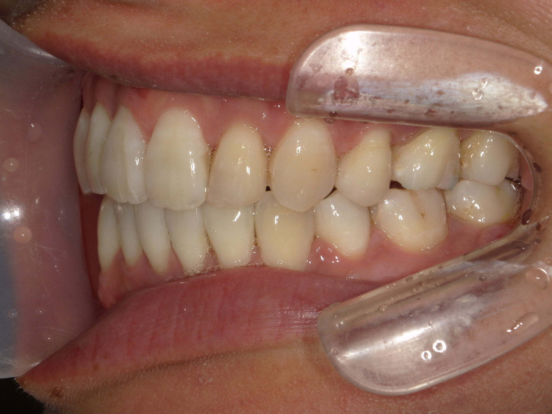 舌側ワイヤー矯正　症例（30）