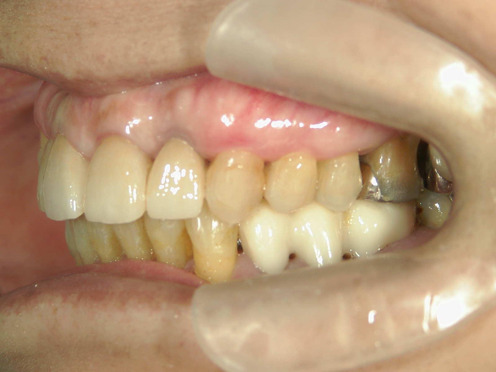 補綴併用症例（2）