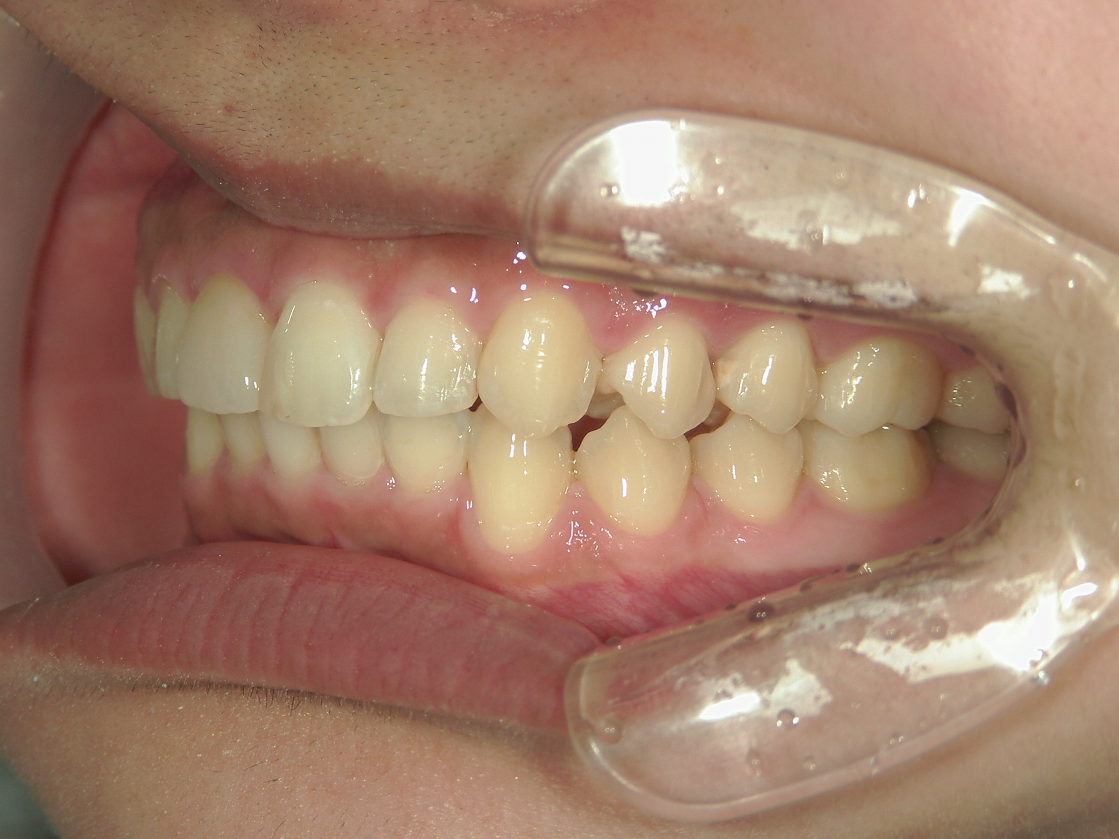 補綴併用症例（3）