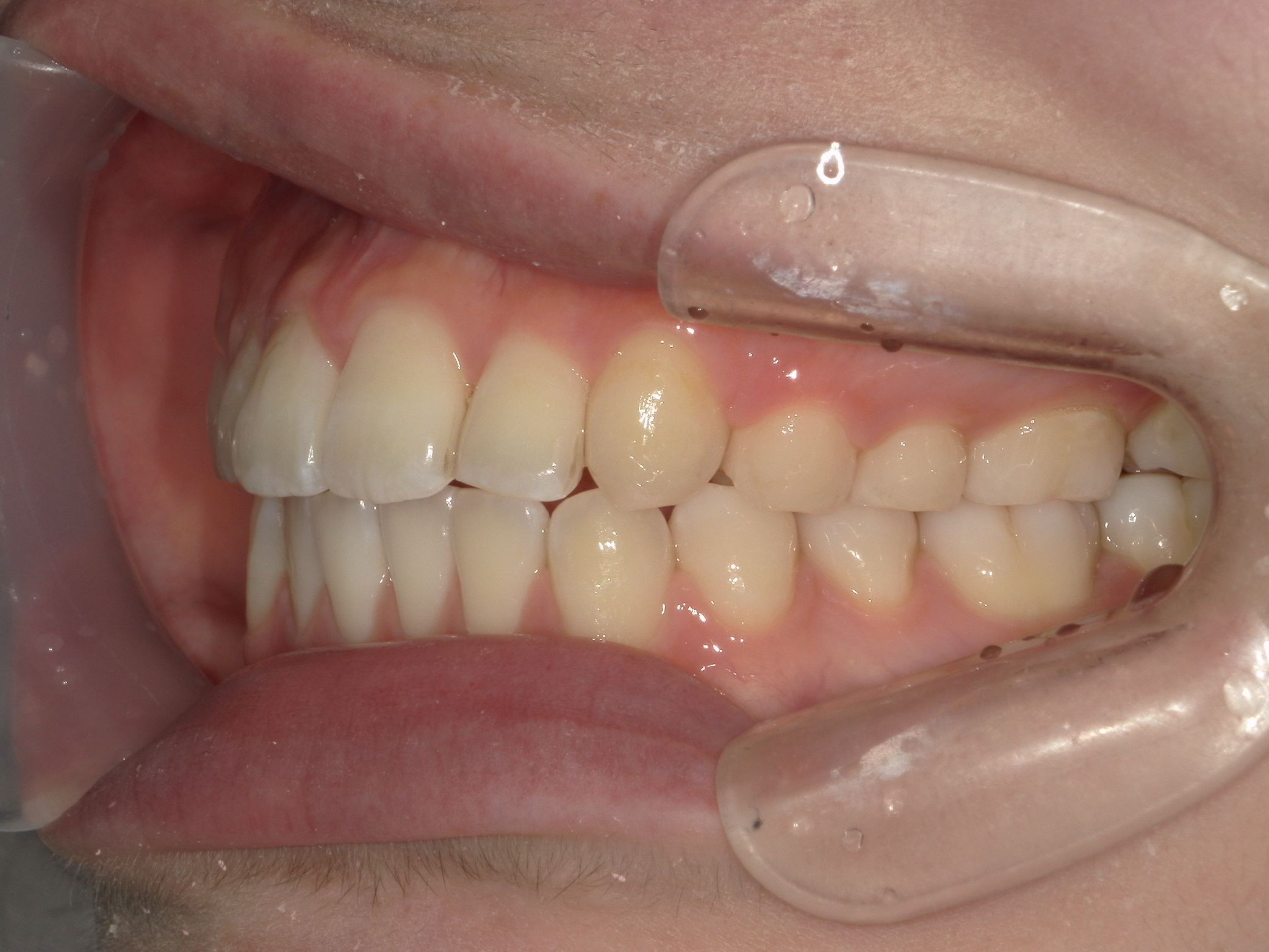 インビザライン矯正　症例（22）