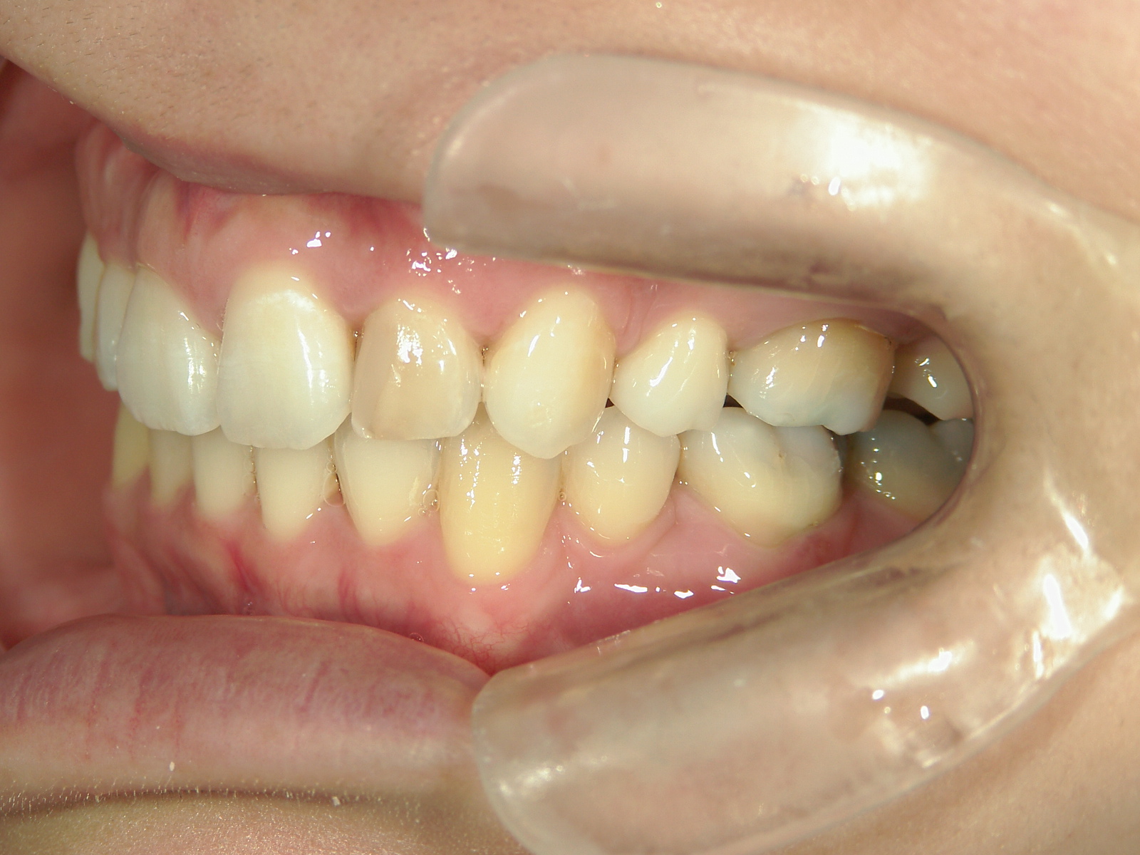 舌側ワイヤー矯正　症例（25）